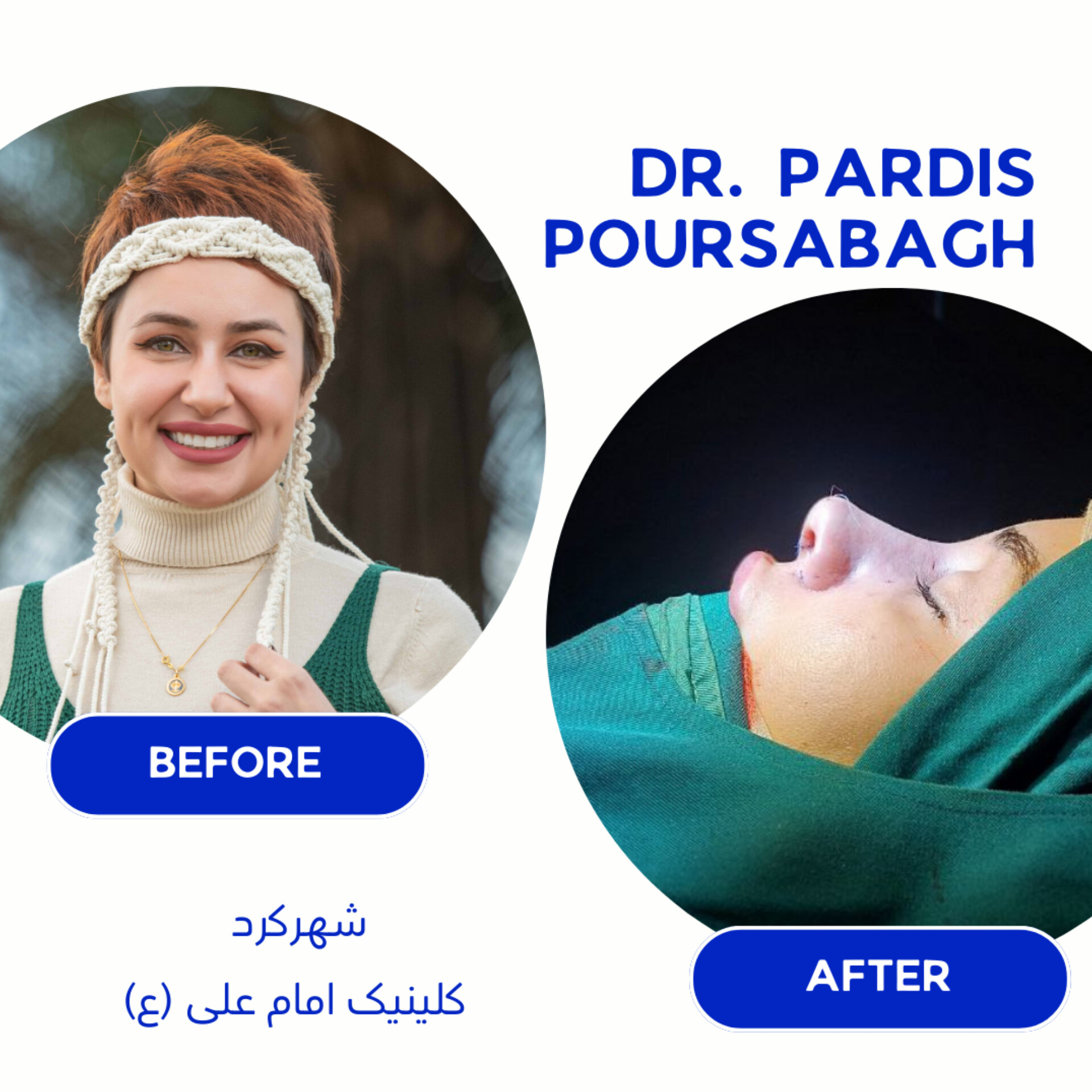نمونه جراحی بینی زیباجو